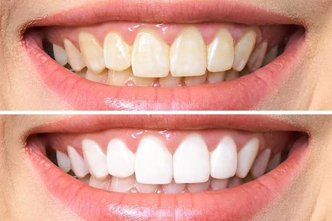 La Première Brosse à Dents électrique intelligente avec Technologie LED Blanchissante Intégrée"